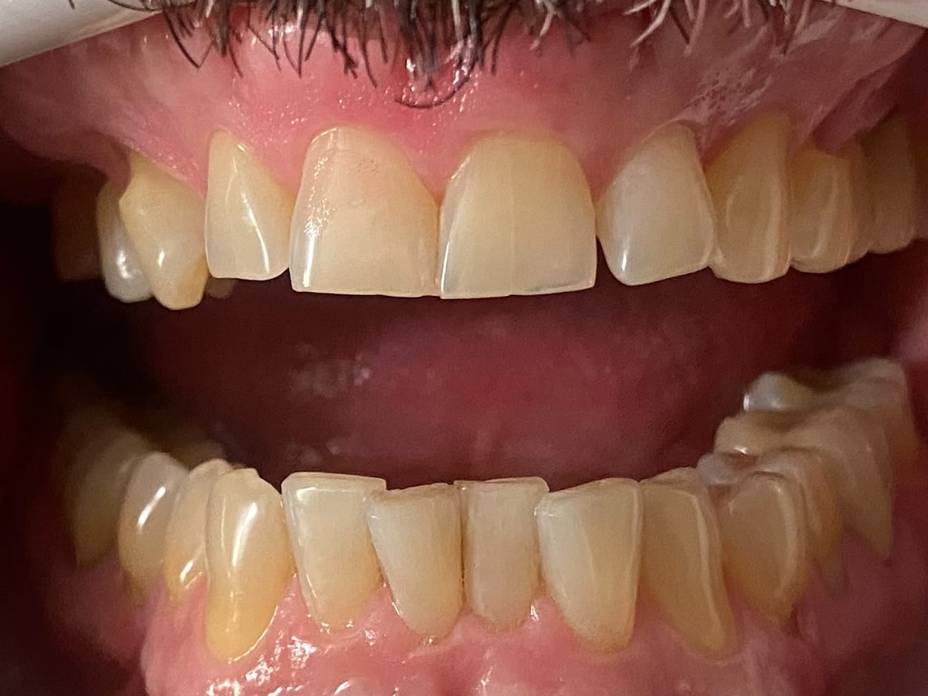 Antes do clareamento dental, paciente do Dr. Pedro Henrique Pinto