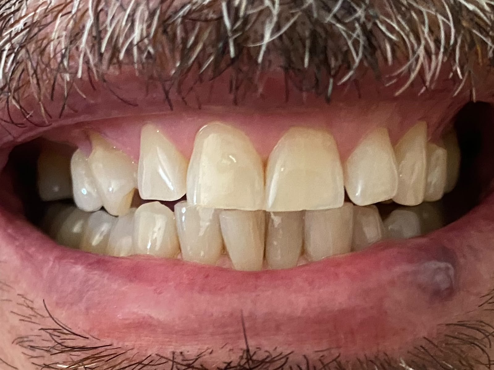 Depois do clareamento dental, paciente do Dr. Pedro Henrique Pinto