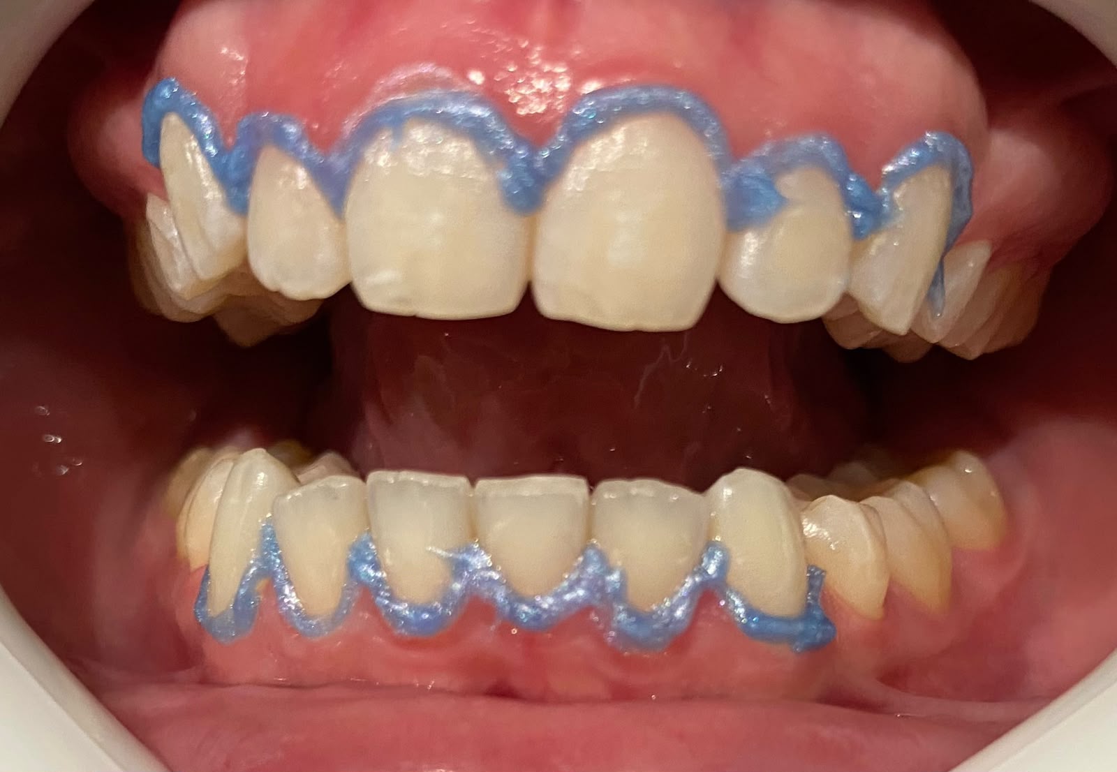 Antes do clareamento dental, paciente do Dr. Pedro Henrique Pinto